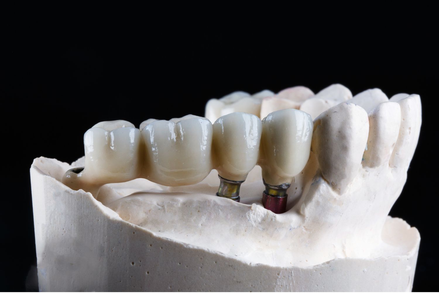 Puente dental sobre implantes en modelo