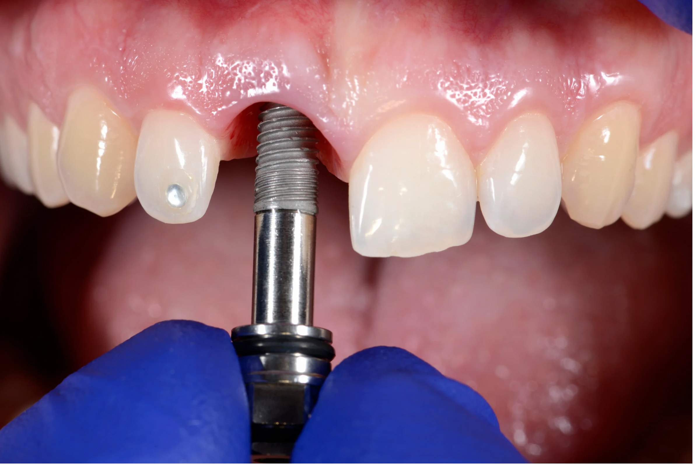 Dental Implants & Tooth Replacement