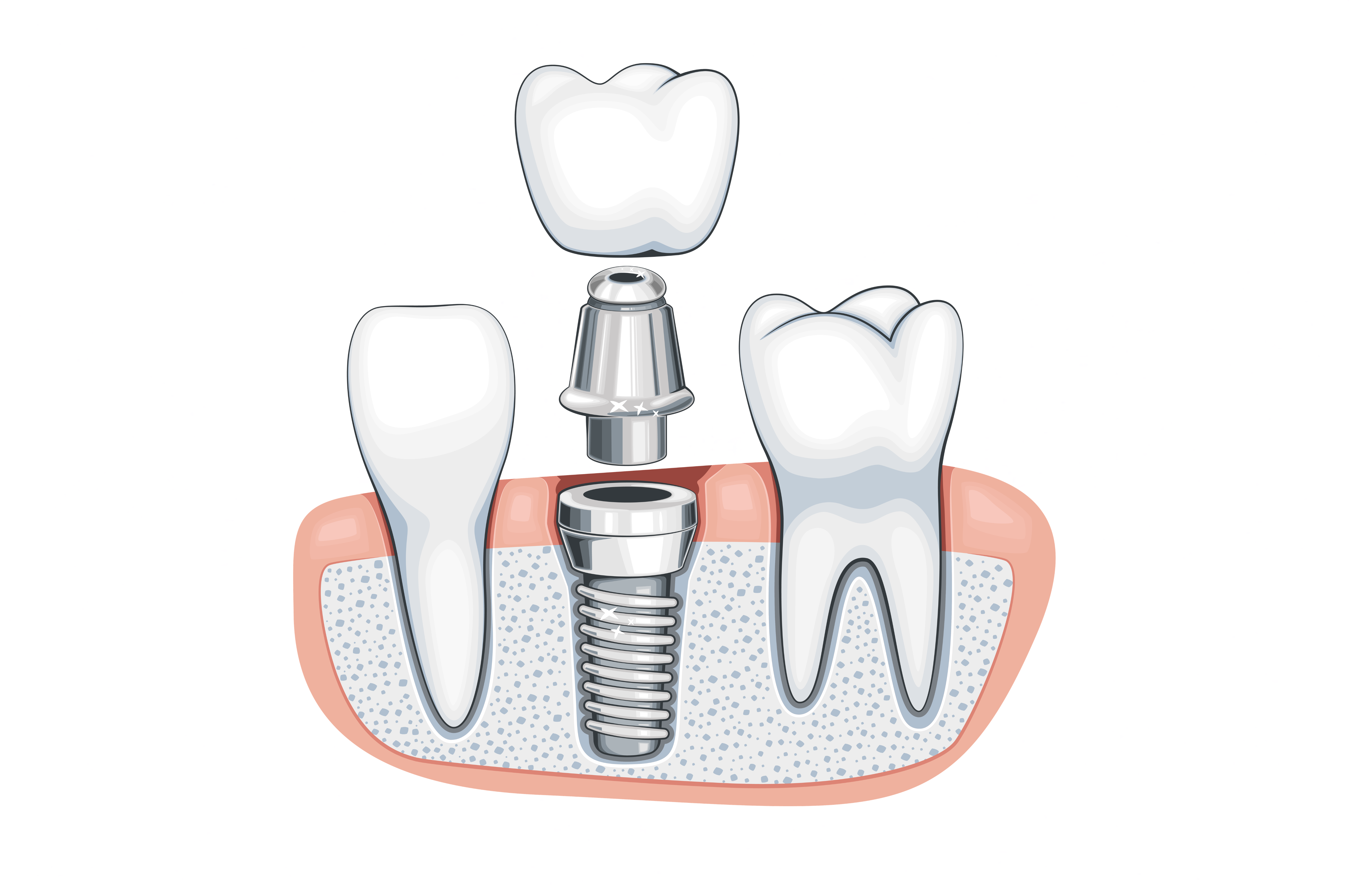 Dental Implants & Tooth Replacement
