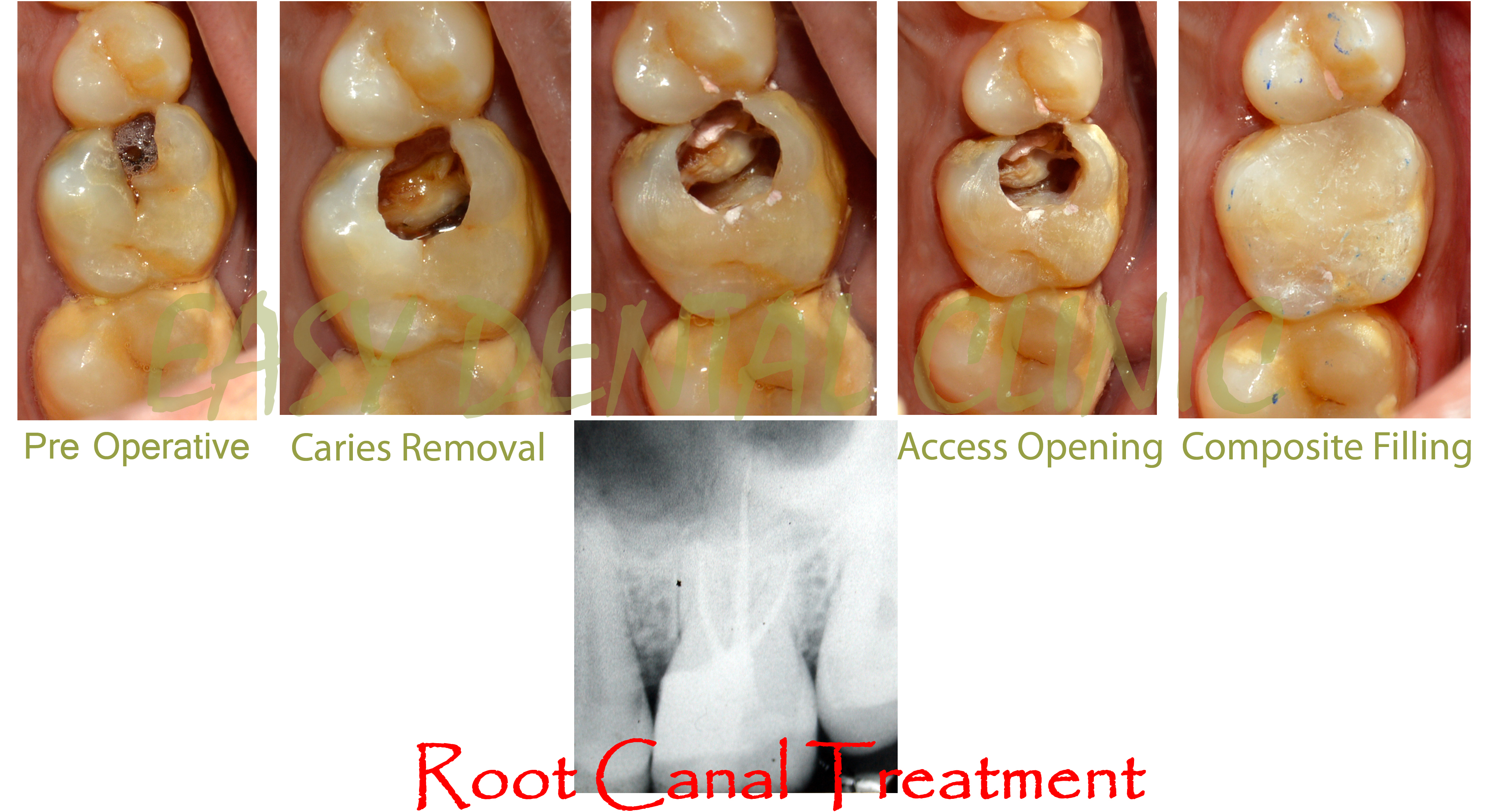 Root Canal Treatment