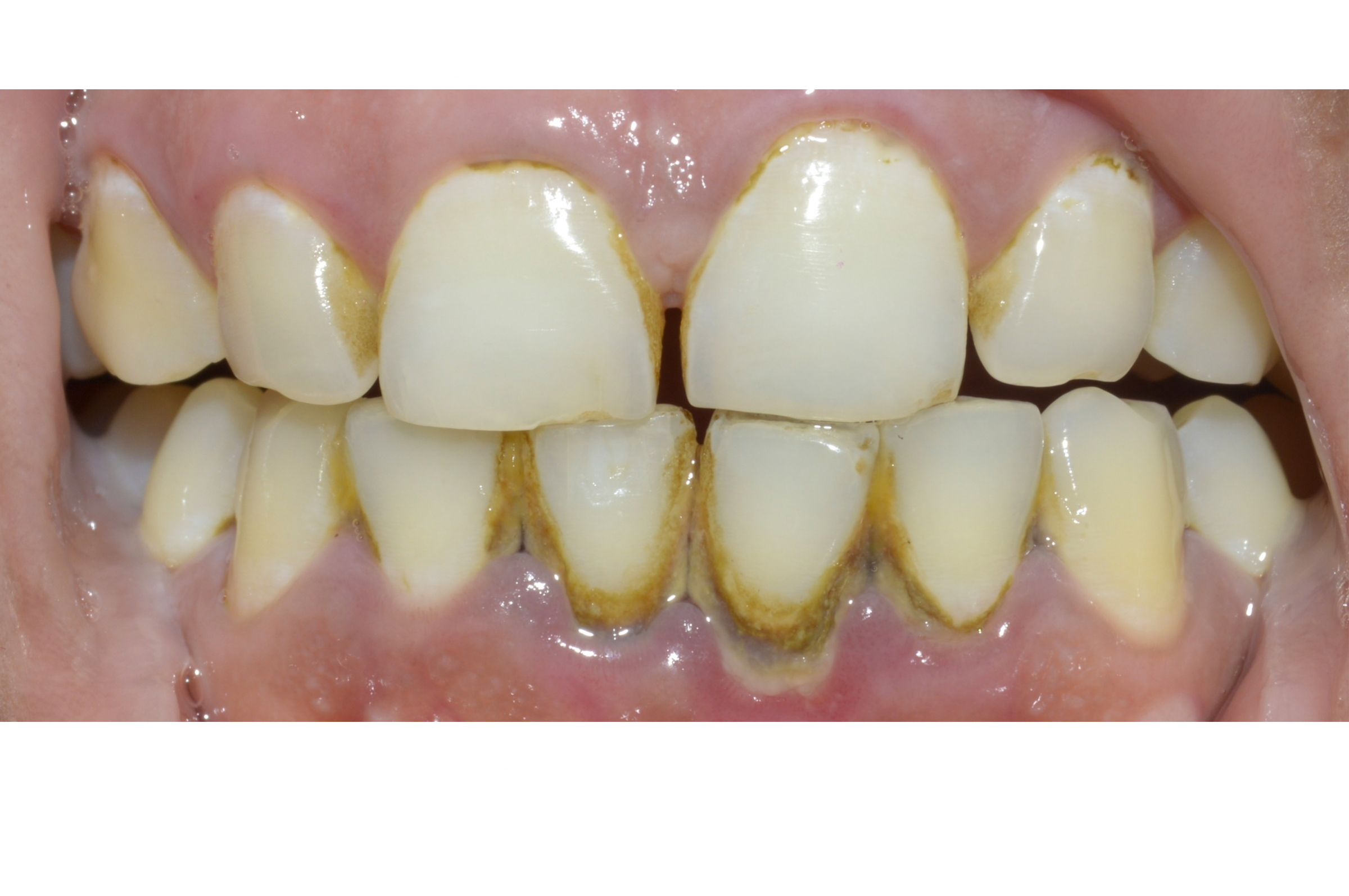 Teeth cleaning — Before