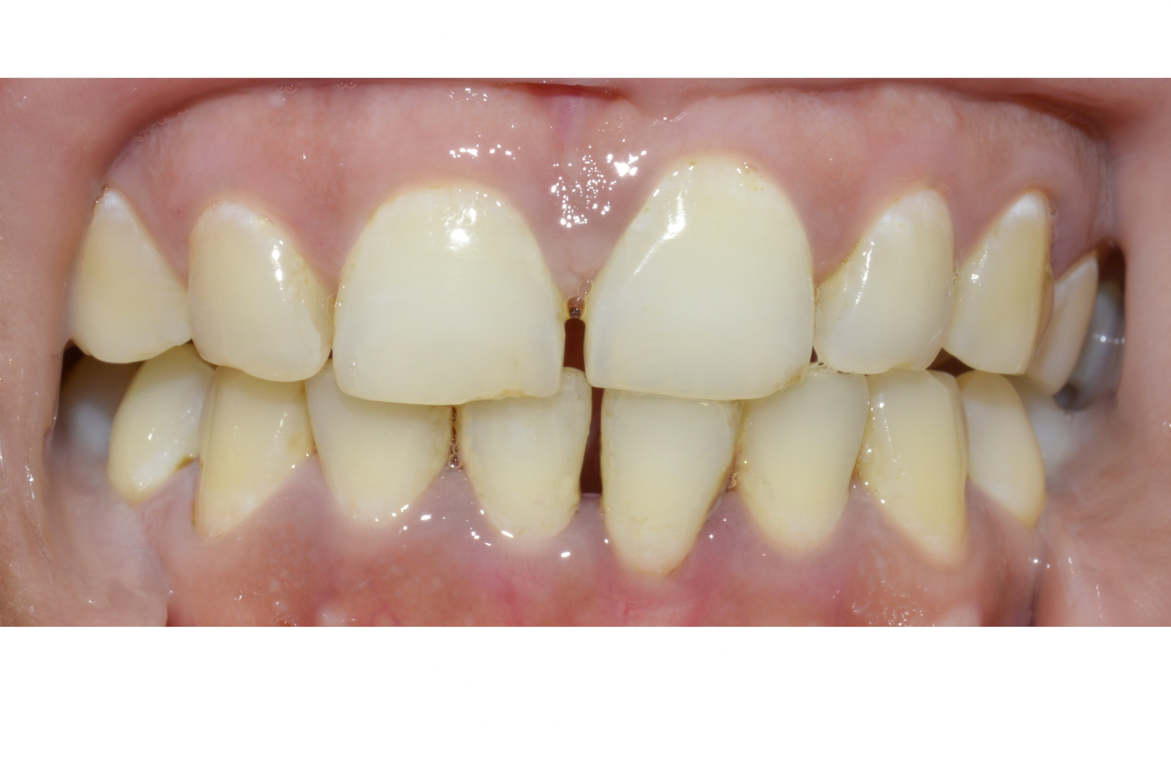 Teeth cleaning — After