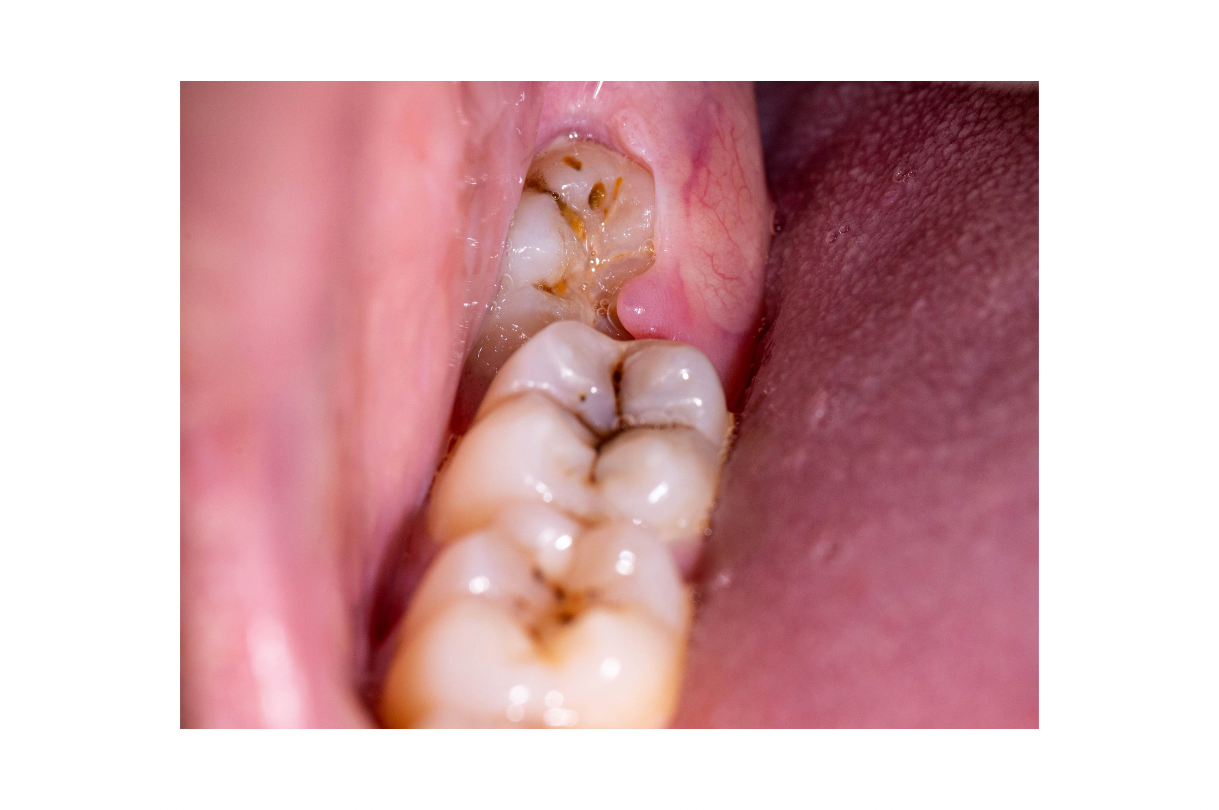 Wisdom Tooth & Minor Oral Procedures