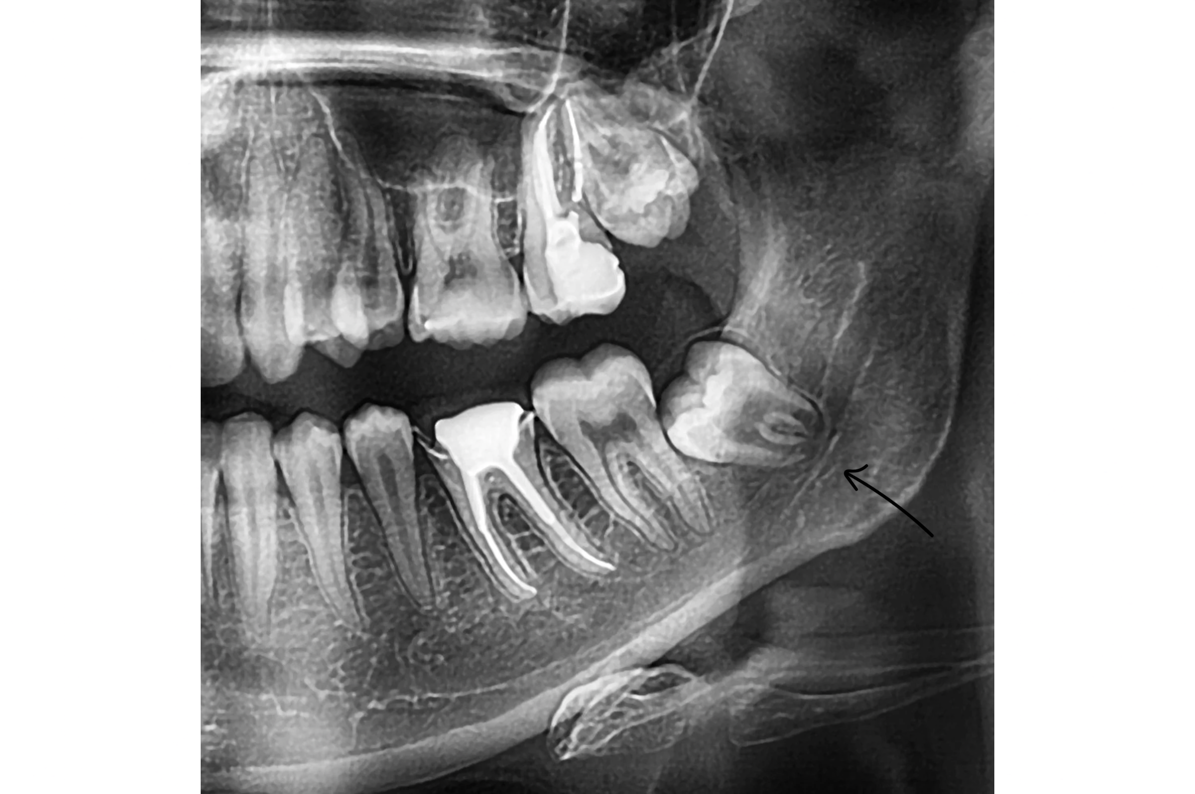 Wisdom Tooth & Minor Oral Procedures