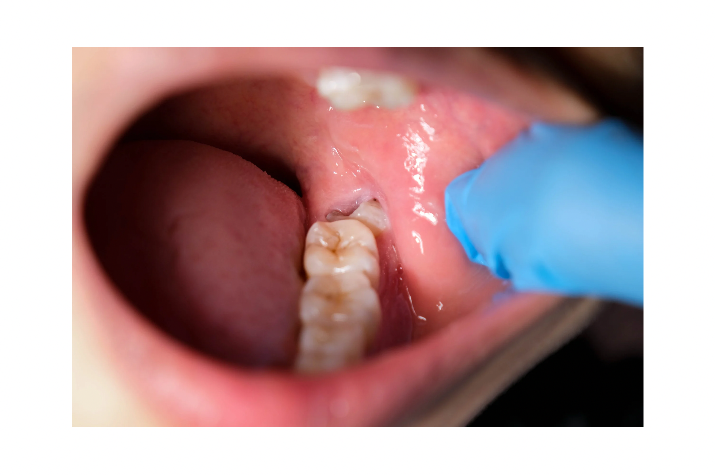 Wisdom Tooth & Minor Oral Procedures