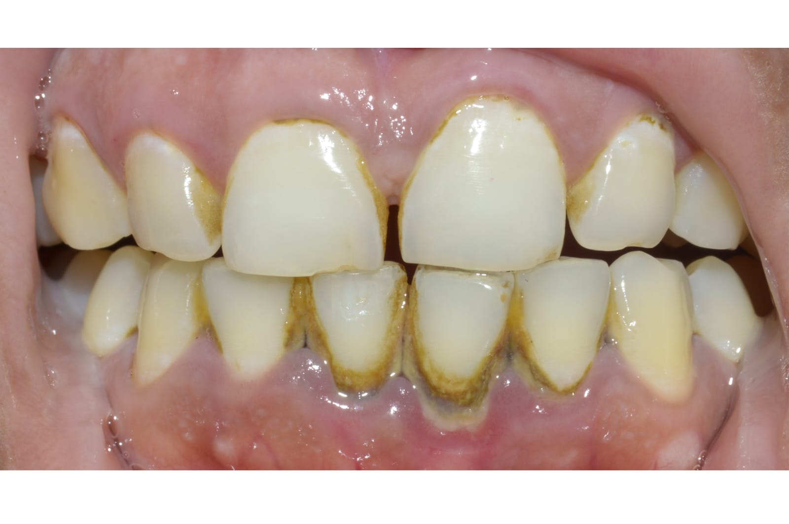 Does Scaling Make Your Teeth Weak? And Why Do Gaps Sometimes Appear After Cleaning?