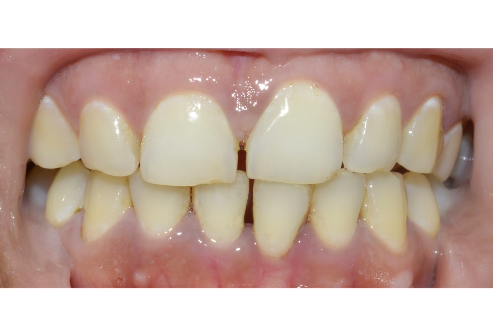 Does Scaling Make Your Teeth Weak? And Why Do Gaps Sometimes Appear After Cleaning?