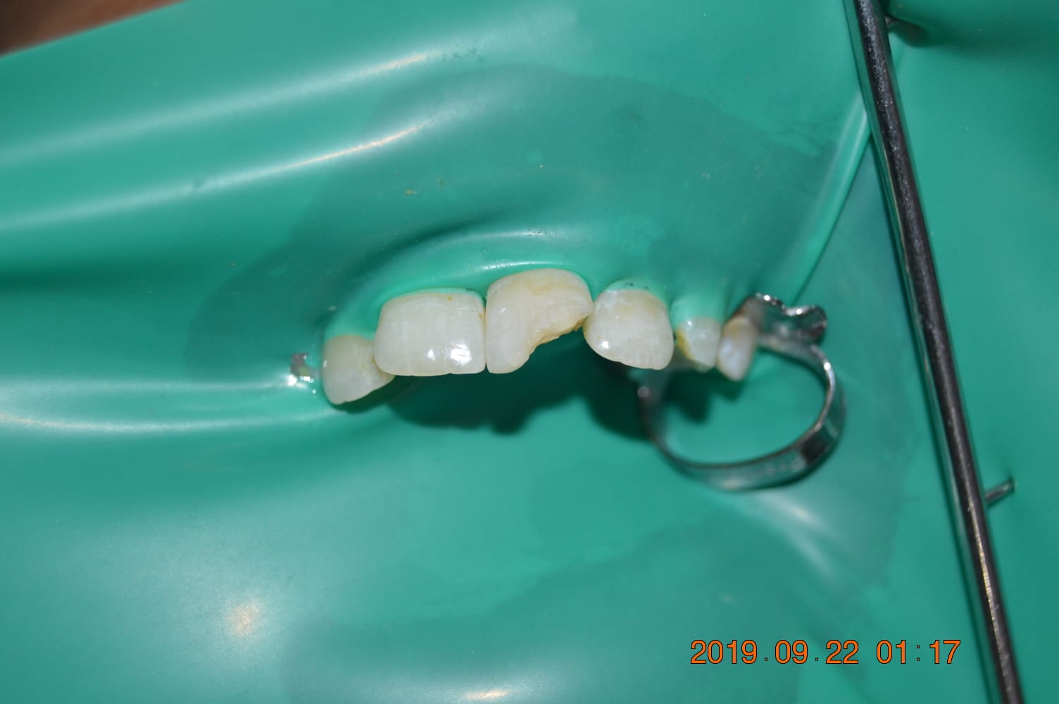 A Broken Front Tooth, Restored to Look Natural Again