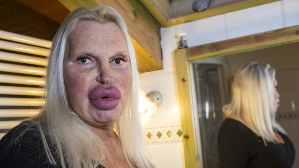 Käytti 70 000 euroa kauneusleikkauksiin - Miten meni, noin niinku omasta mielestä?