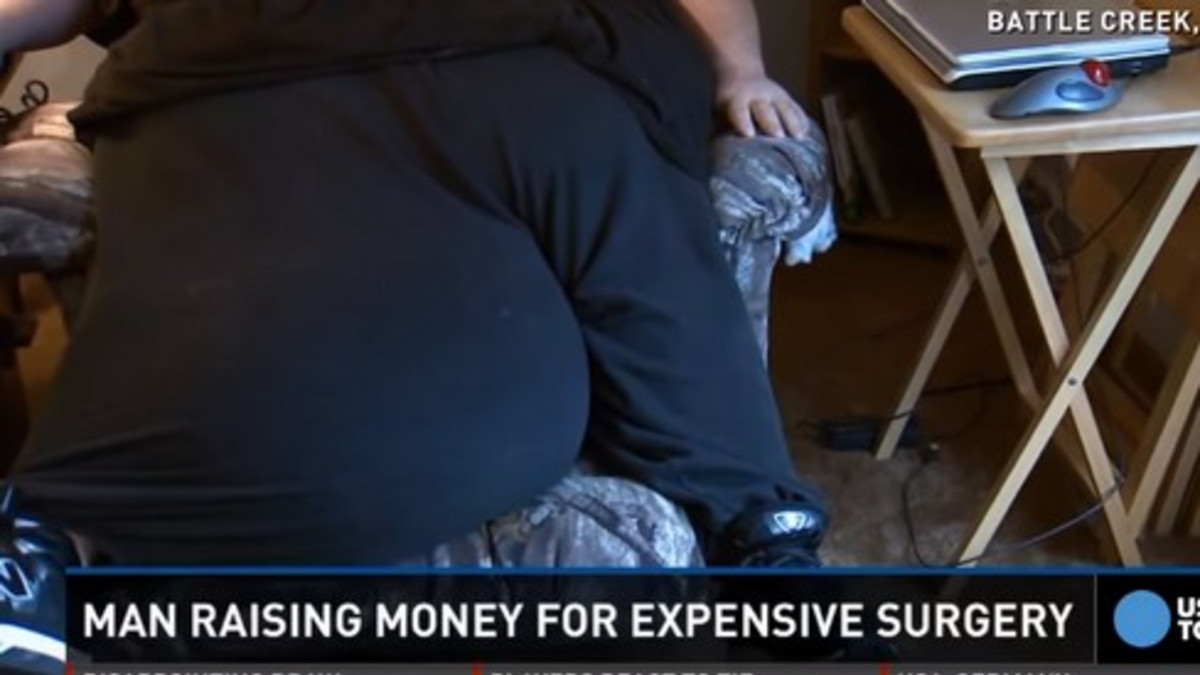 45 kg! Miehen kivespussit kasvaneet jättimäisiksi
