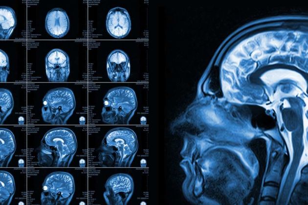 Brain MRI Brain MRI