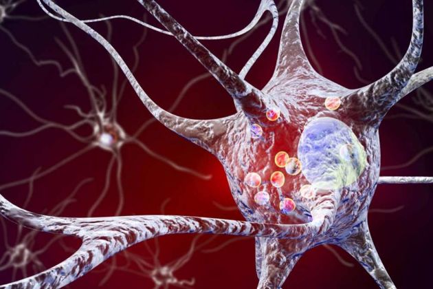 Parkinson's disease Parkinson's disease