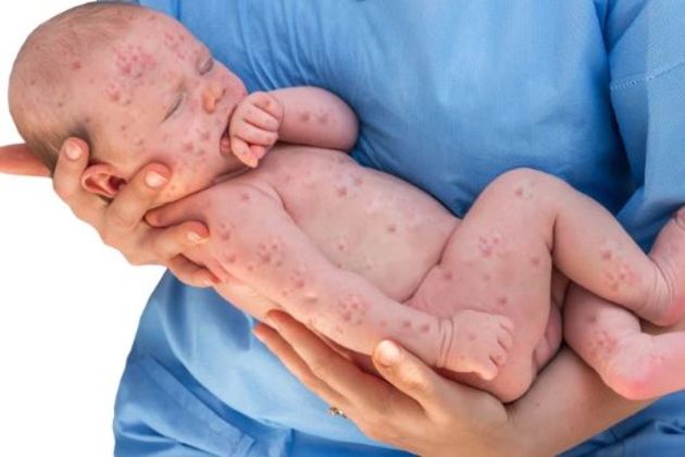 Measles Measles