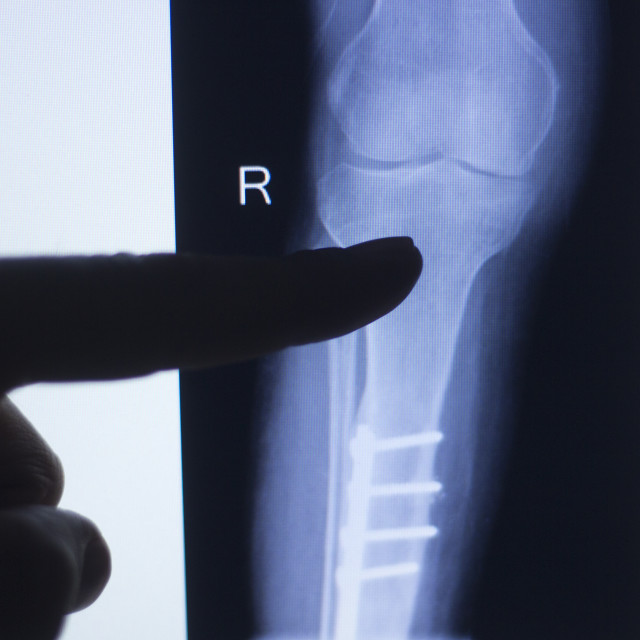 "Knee joint xray test scan" stock image