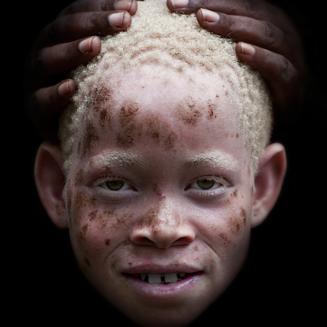 "Zamda, Albino girl in mikindani, Tanzania" stock image. 