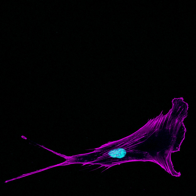 "Immunofluorescence confocal imaging of a single invading metasta" stock image