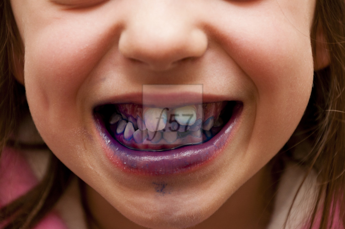"Child using disclosing tablets to show plaque on teeth" stock image