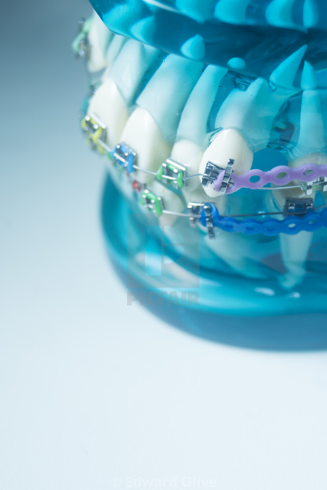 "Metal teeth brackets" by Edward Olive - £11.15 "Metal teeth brackets" stock image