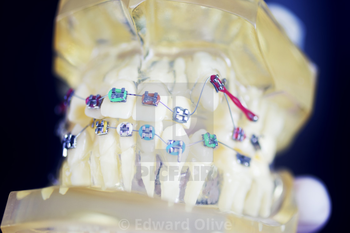 "Dental teeth aligners brackets" by Edward Olive - £11.15 "Dental teeth aligners brackets" stock image