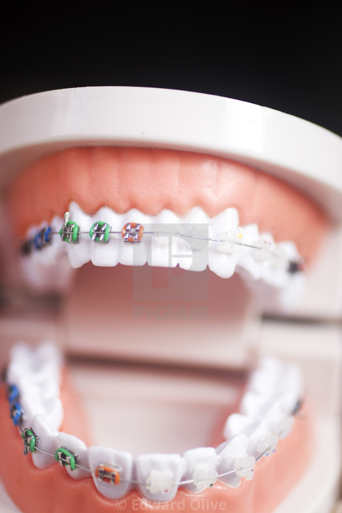 "Dental teeth aligners brackets" by Edward Olive - £11.15 "Dental teeth aligners brackets" stock image