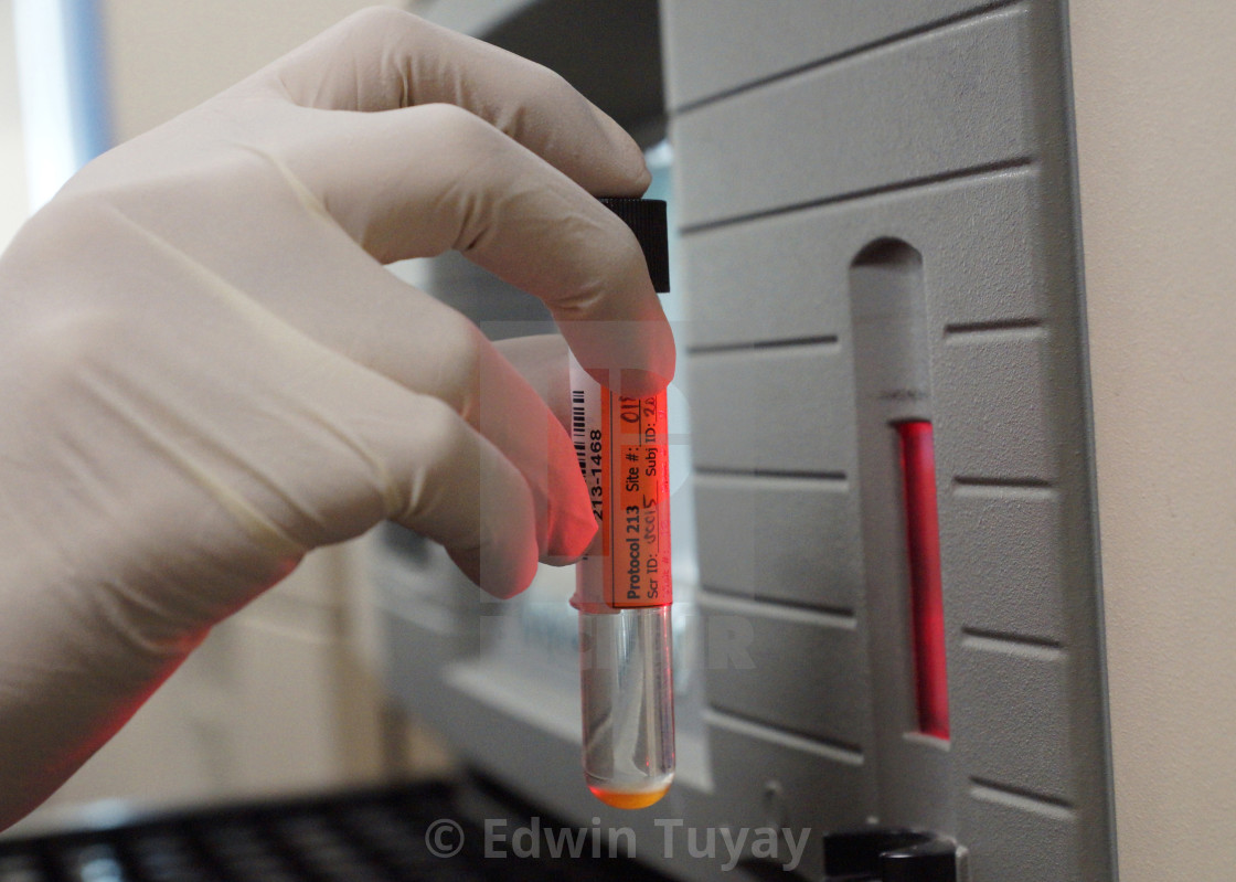 "Sputum on test tube" by Edwin Tuyay - $43.58 "Sputum on test tube" stock image