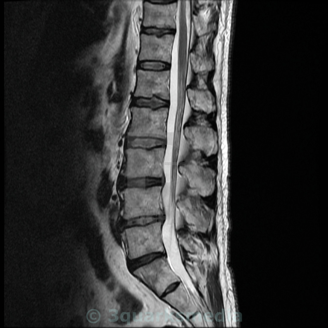 "MRI of a Lumbar-Disk Herniation" by 3quarksmedia - £ 9.92. 