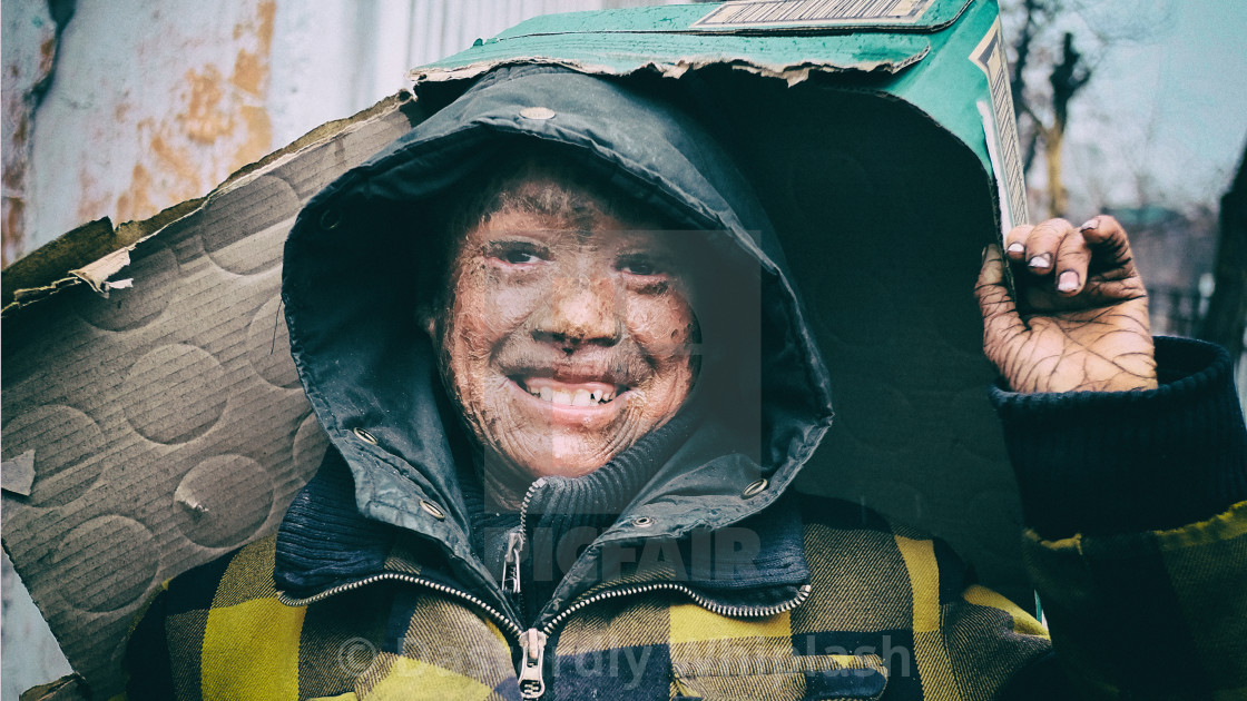 "The boy with the flash burns" stock image