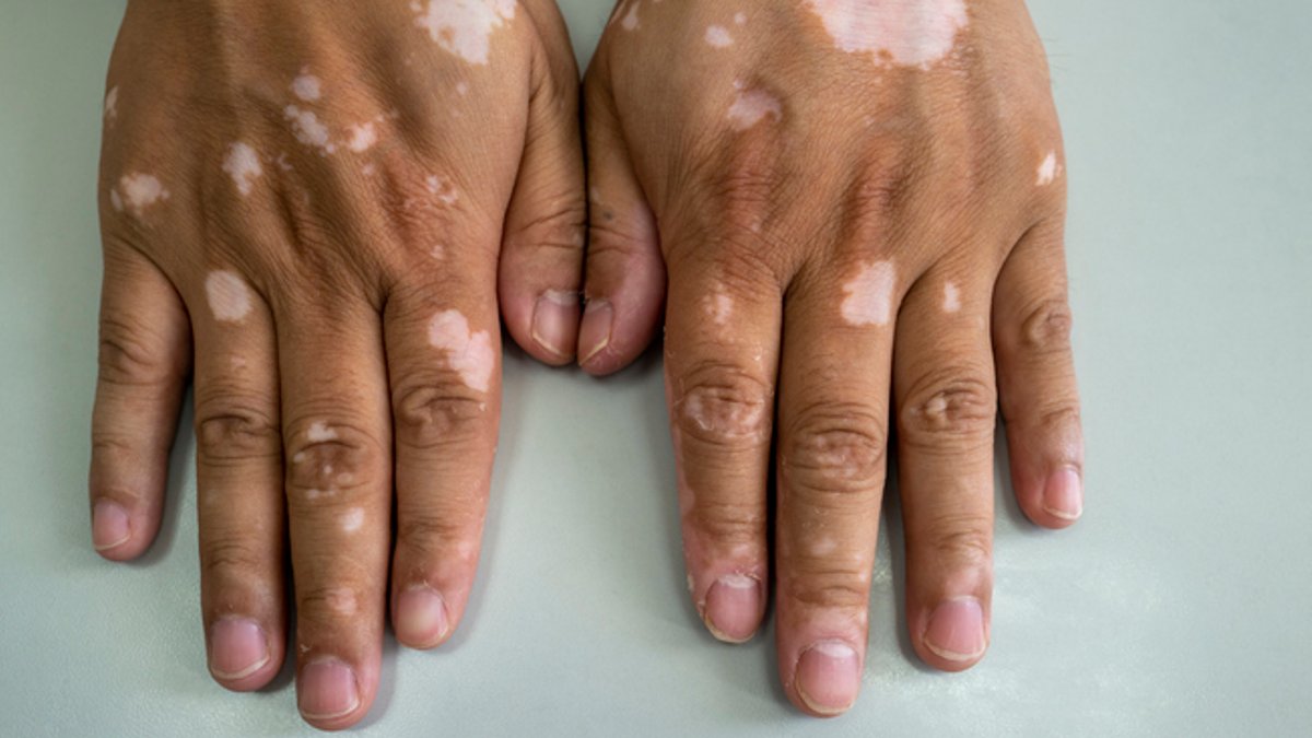 Pfizer submits vitiligo data for oral drug approval - vitiligo drug approval