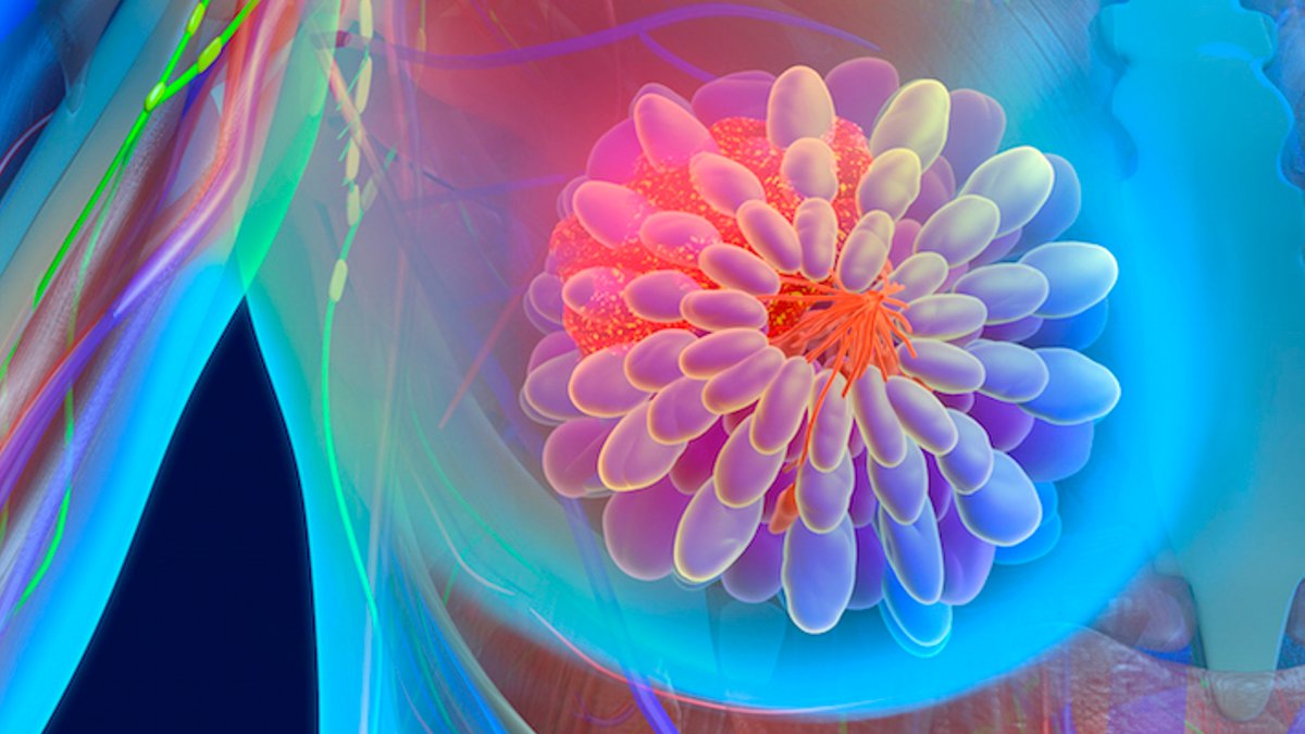 Enzyme FAH may predict CDK4/6 inhibitor resistance in breast cancer - breast cancer