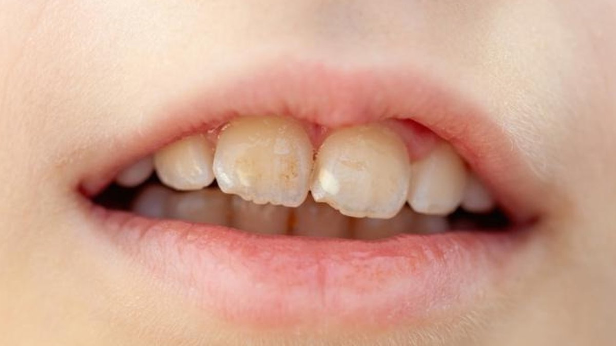 Acid Erosion Damages Tooth Enamel Irreversibly - tooth enamel