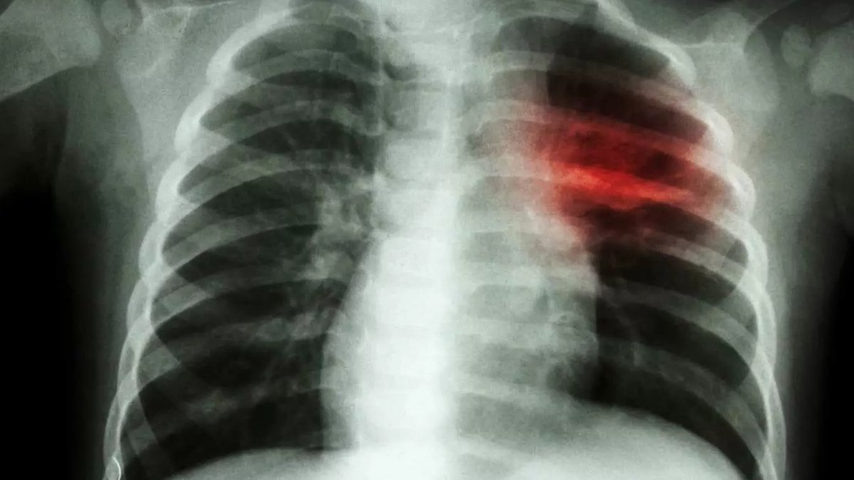 Longer Steroid Use Linked to Extended Hospital Stays in AECOPD