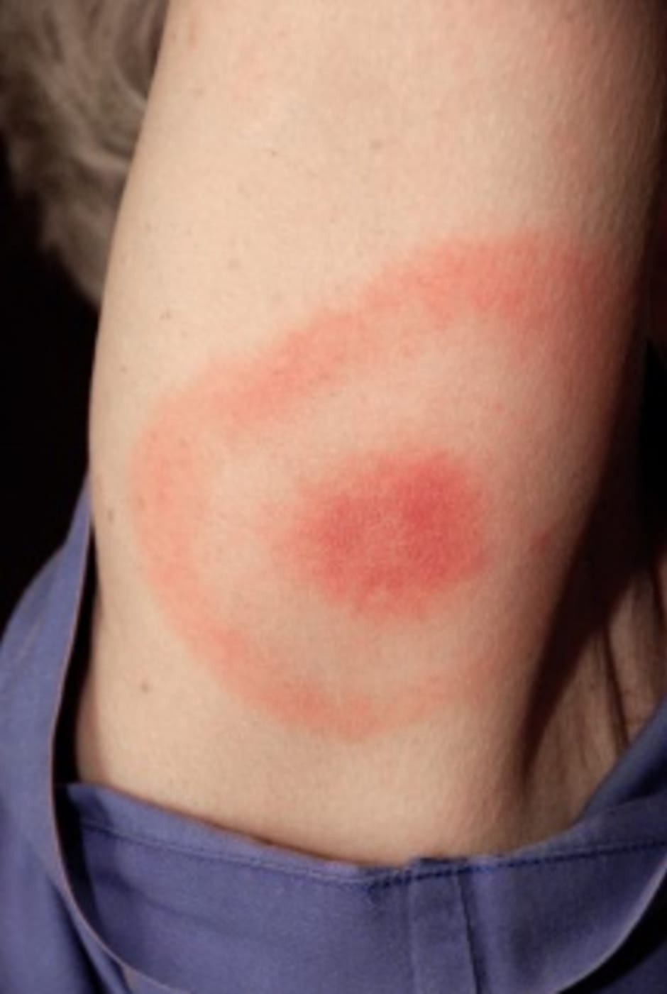 Typische erythema migrans