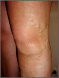 The risks of varicose veins