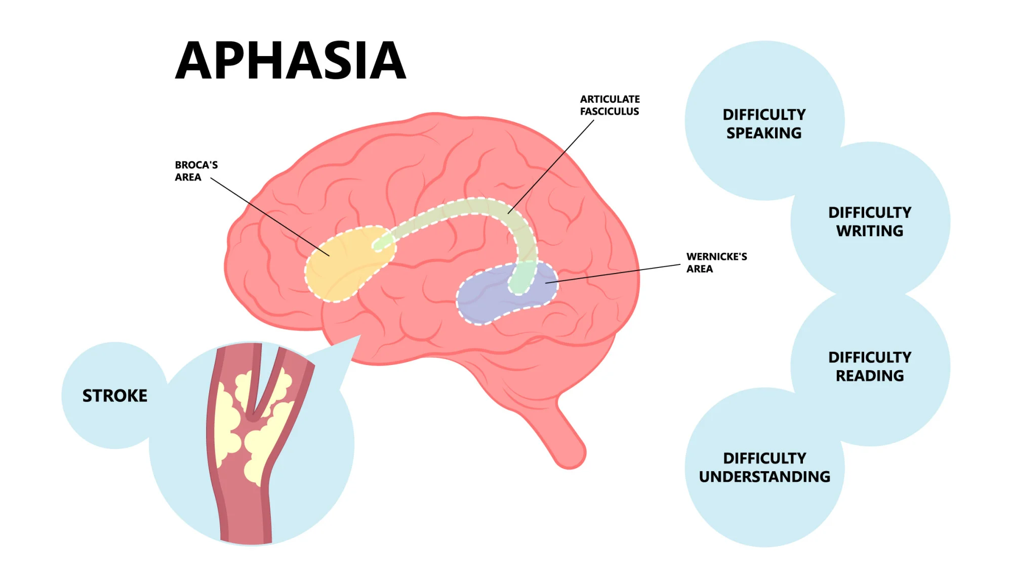 Do You Have Aphasia? Take Our Quick Quiz to Find Out!