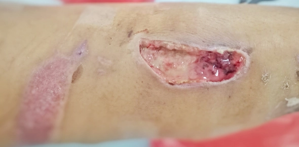 Pressure Ulcers Trivia: Test Your Knowledge on Prevention and Care