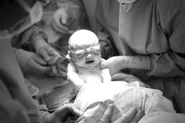 India's changing birth story shows the rise of Caesarean deliveries