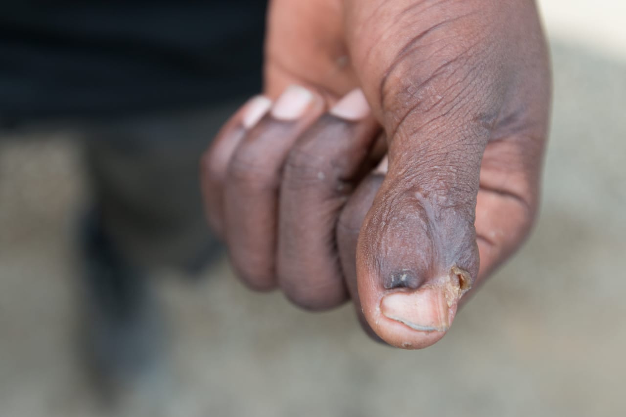 Tratamento de um corte num dedo
