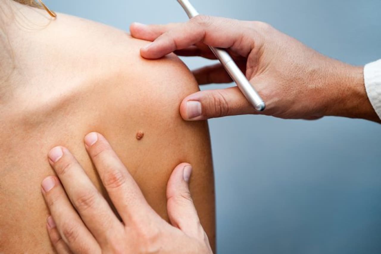 Plastic surgeon examining mole for skin cancer