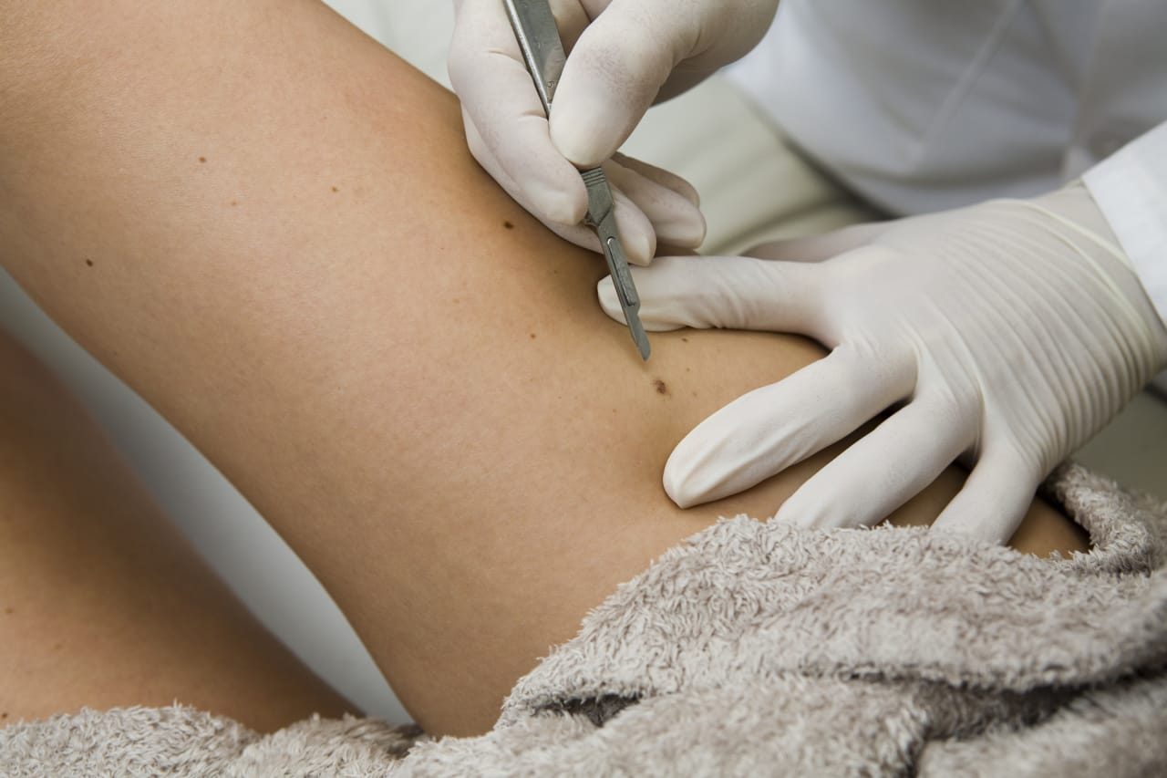 Skin cancer treatment options including biopsy, excision, Mohs surgery, and reconstruction with Dr. Garazo in Maryland