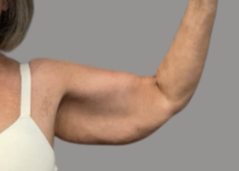 Arm lift before front view, case 05