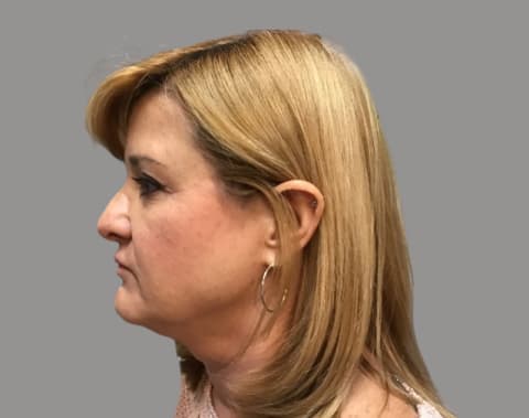 Facelift before left view, case 06
