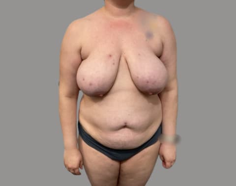 Mommy makeover before front view, case 02