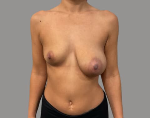 Breast asymmetry before front view, case 07