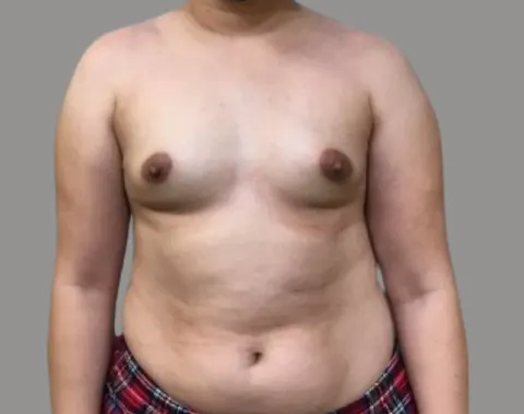 Breast augmentation before front view, case 65