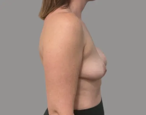 Breast augmentation before right side view, case 24