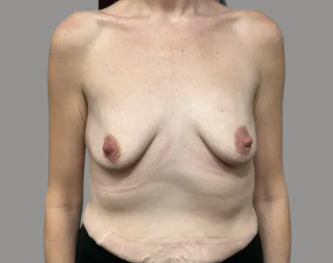 Breast augmentation before front view, case 69