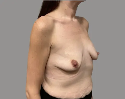 Breast augmentation before right oblique view, case 69