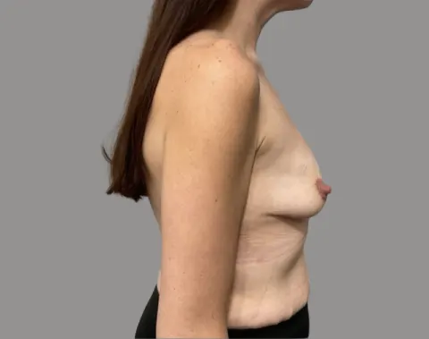 Breast augmentation before right side view, case 69
