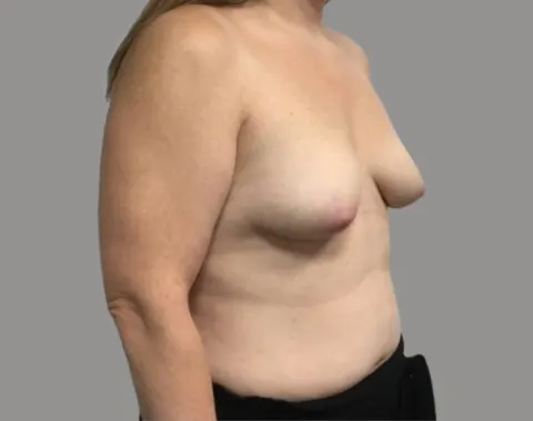 Breast augmentation before right oblique view, case 70