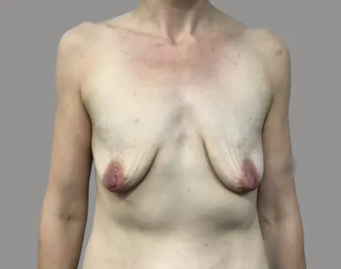 Breast augmentation before front view, case 72